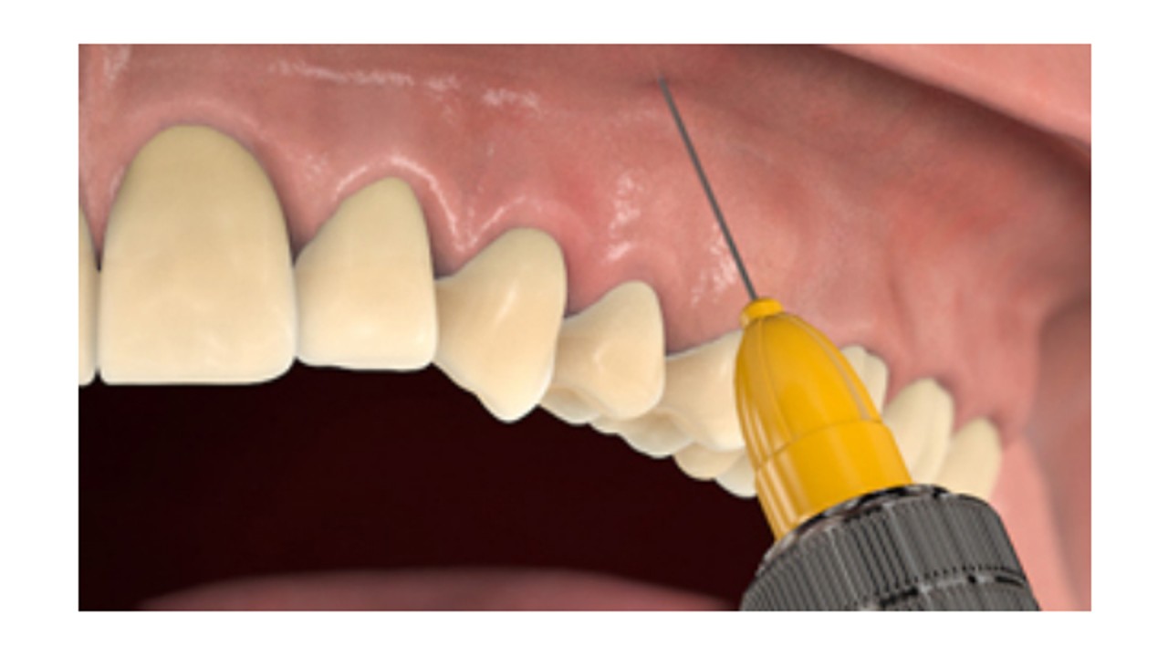 Local anaesthetic