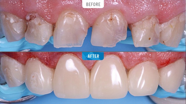 Restauration stark beschädigter Frontzähne mit Pearl MEDIUM. Fall von Dr. Fraser Tait, UK.